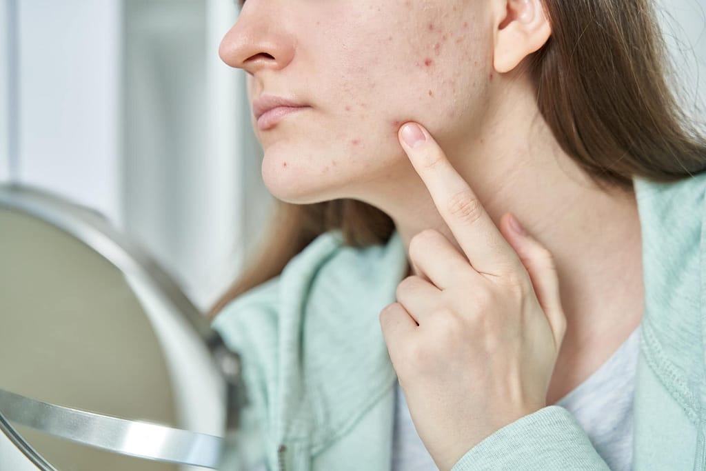 Portrait of young teenage girl having problems with skin. Checking and touching irritated face